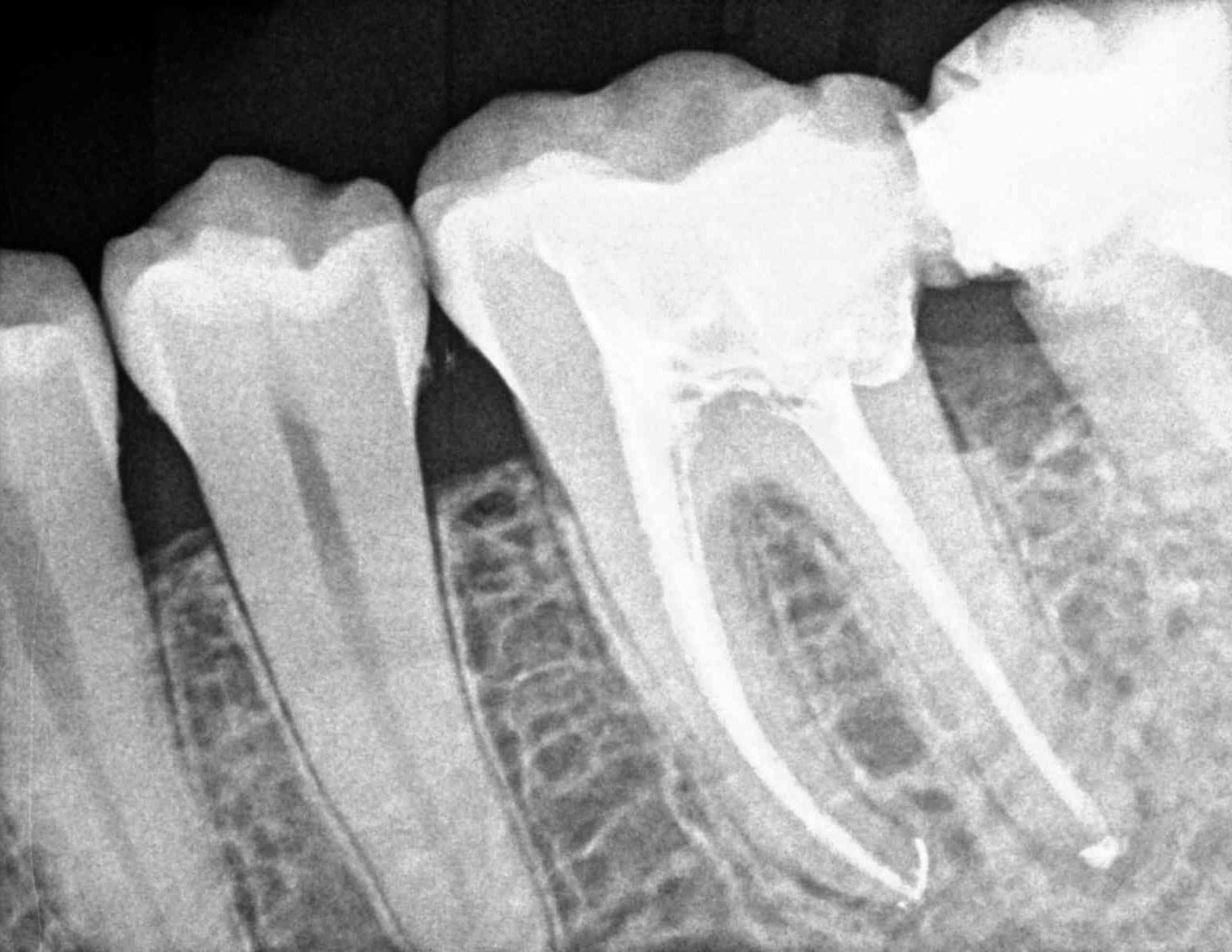  ¿Qué es una endodoncia?