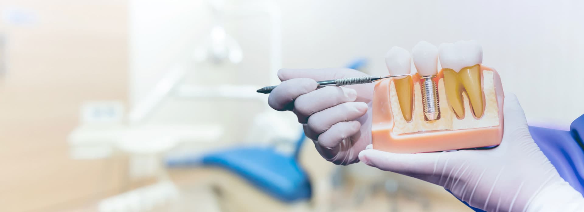 Implantes de mano de la aparatología más moderna