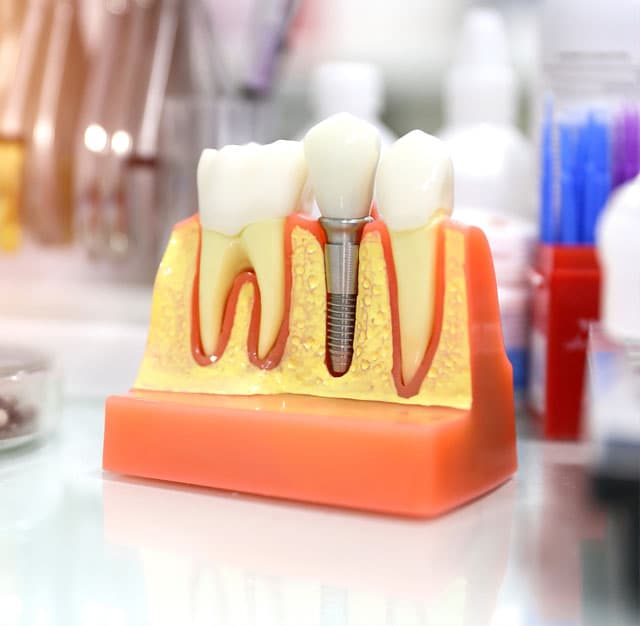 Implantología dental avanzada en Vigo