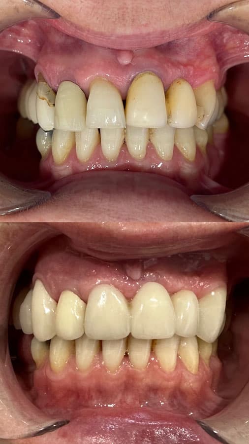 Prótesis - Dent & Dent