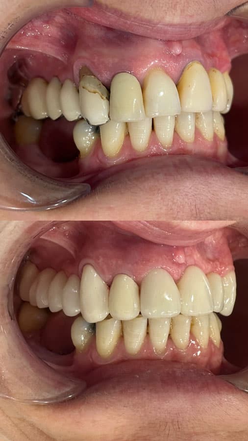 Prótesis - Dent & Dent