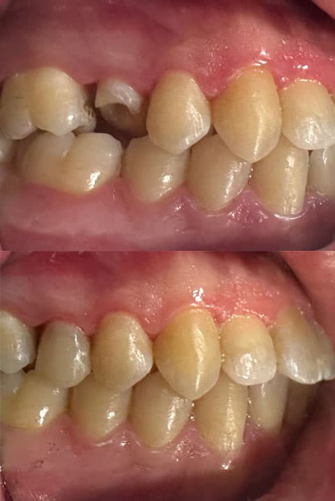 Prótesis - Dent & Dent