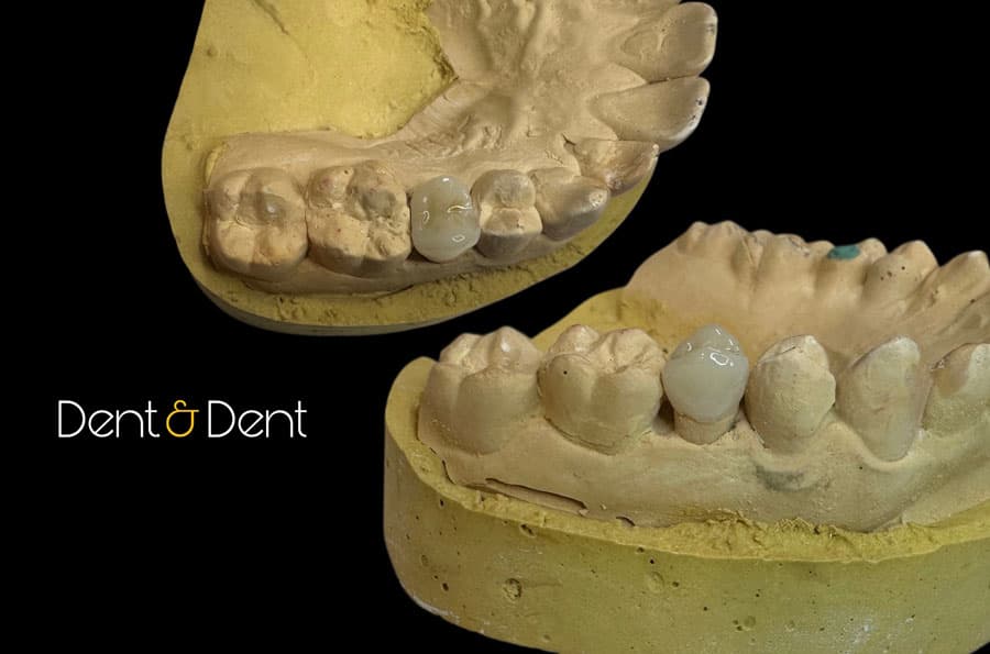 Prótesis - Dent & Dent