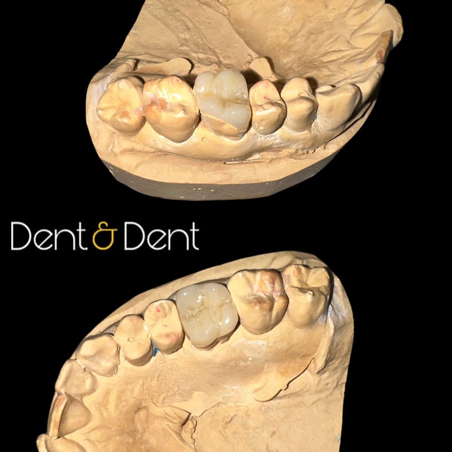 Prótesis - Dent & Dent