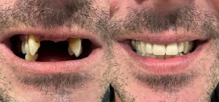 Prótesis - Dent & Dent