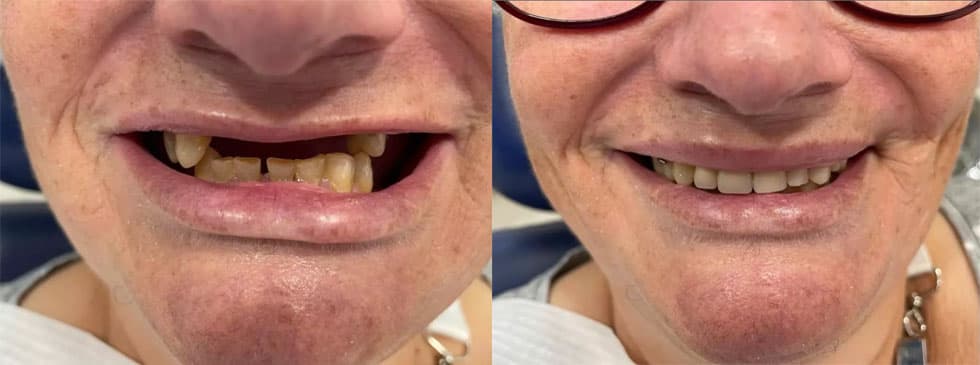 Prótesis - Dent & Dent