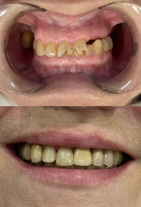 Prótesis - Dent & Dent