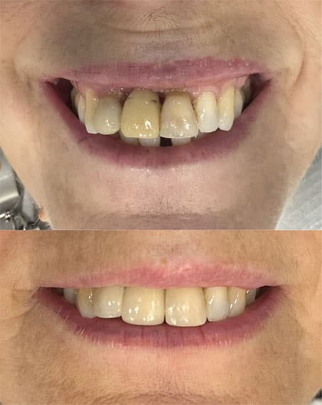 Prótesis - Dent & Dent