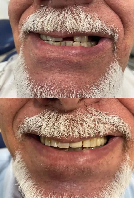 Prótesis - Dent & Dent