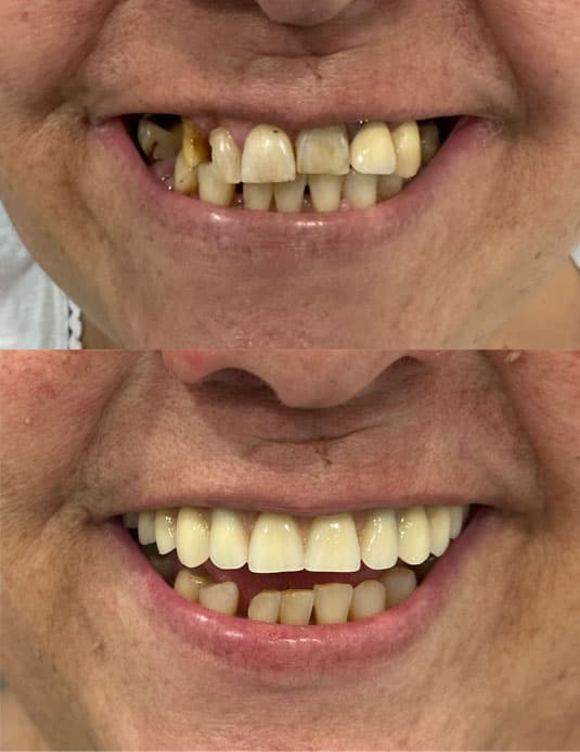 Prótesis - Dent & Dent