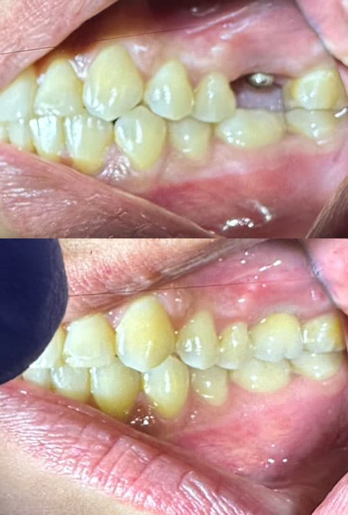 Prótesis - Dent & Dent