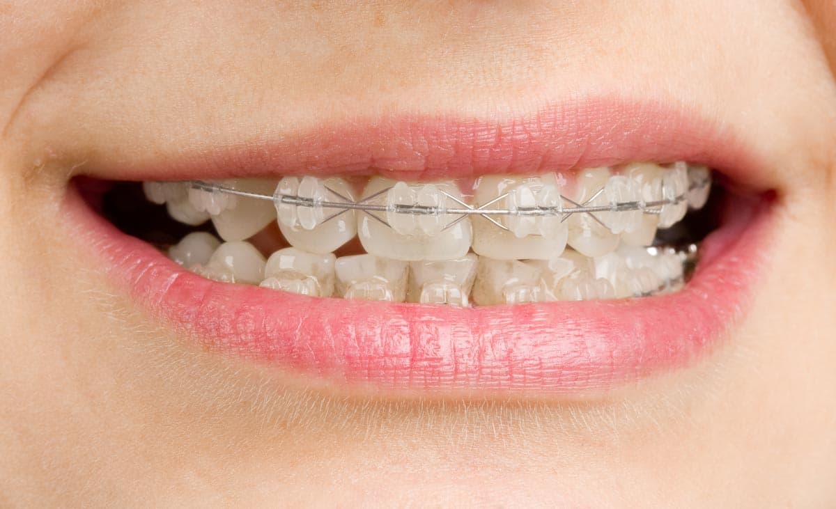 ¿Qué beneficios tienen los brackets? en Vigo