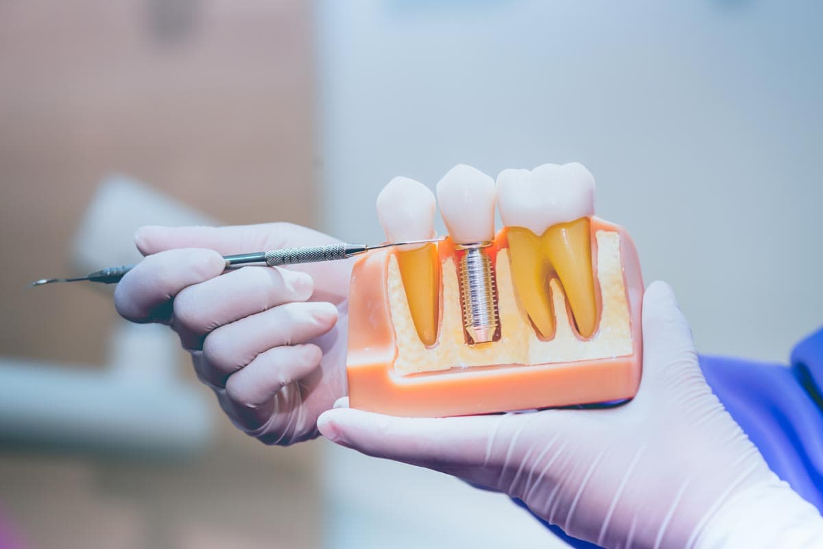 Ventajas de los implantes dentales en Vigo